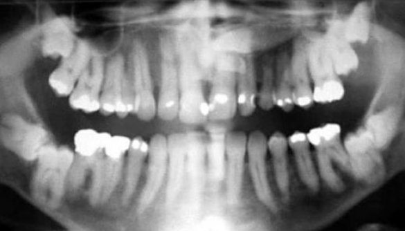 Проблема чутливості зубів